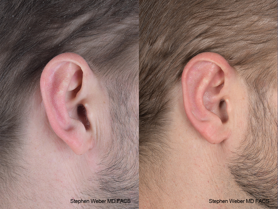 Otoplasty Before and After | Weber Facial Plastic Surgery