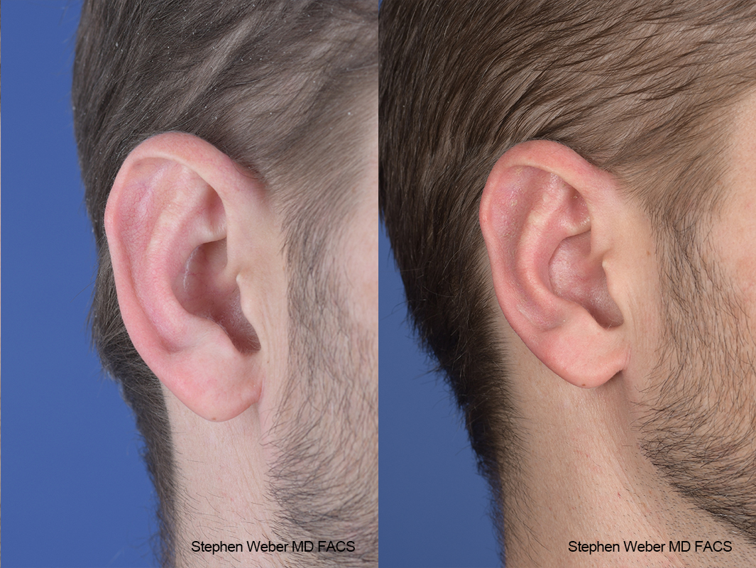 Otoplasty Before and After | Weber Facial Plastic Surgery