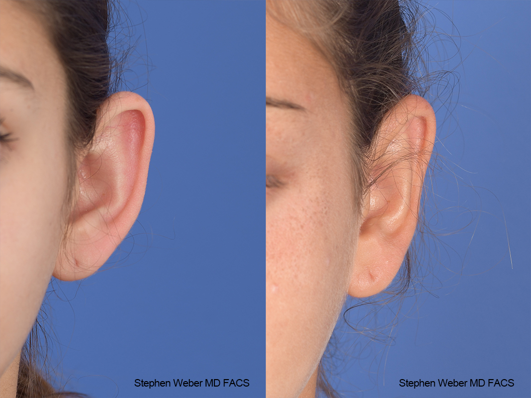 Otoplasty Before and After | Weber Facial Plastic Surgery