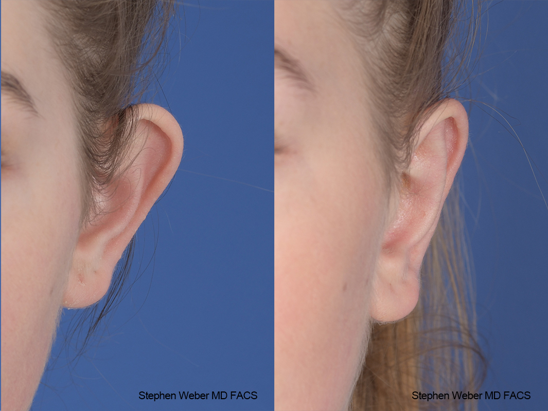 Otoplasty Before and After | Weber Facial Plastic Surgery