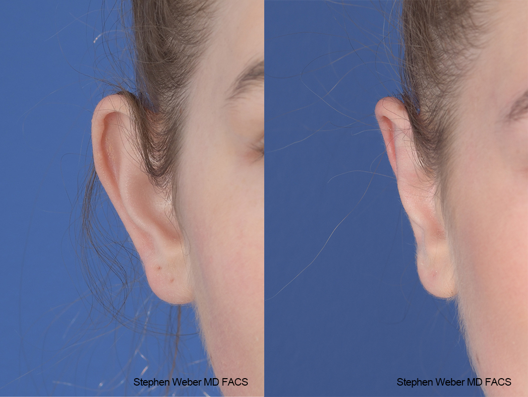 Otoplasty Before and After | Weber Facial Plastic Surgery