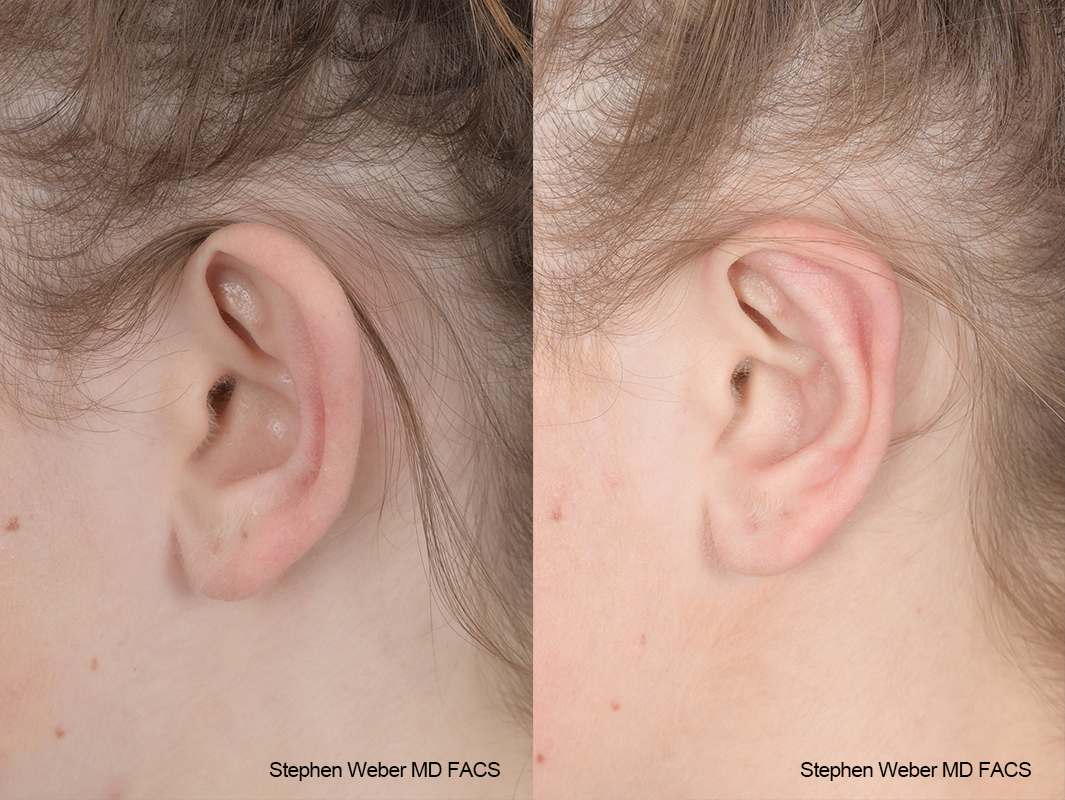 Otoplasty Before and After | Weber Facial Plastic Surgery