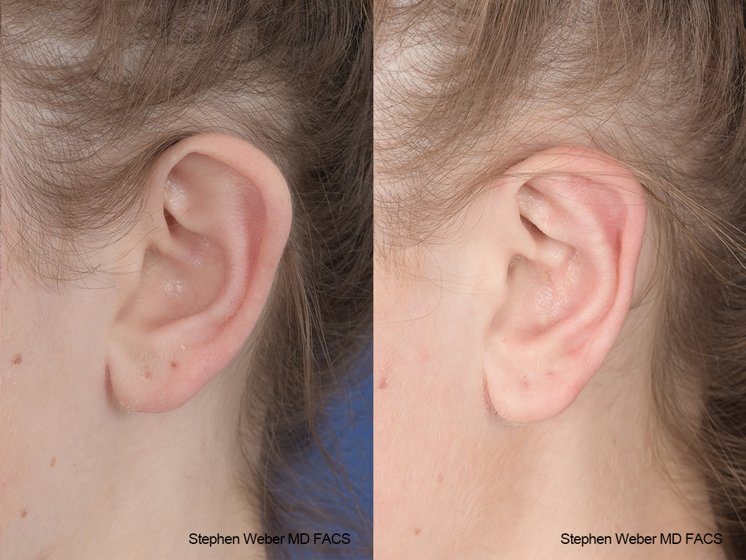Otoplasty Before and After | Weber Facial Plastic Surgery