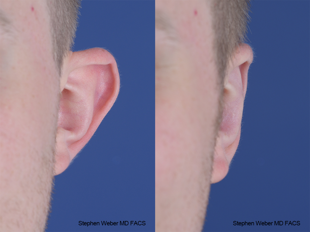 Otoplasty Before and After | Weber Facial Plastic Surgery