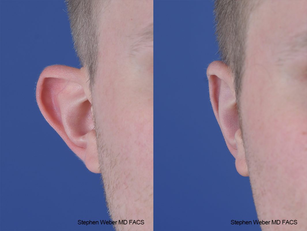 Otoplasty Before and After | Weber Facial Plastic Surgery