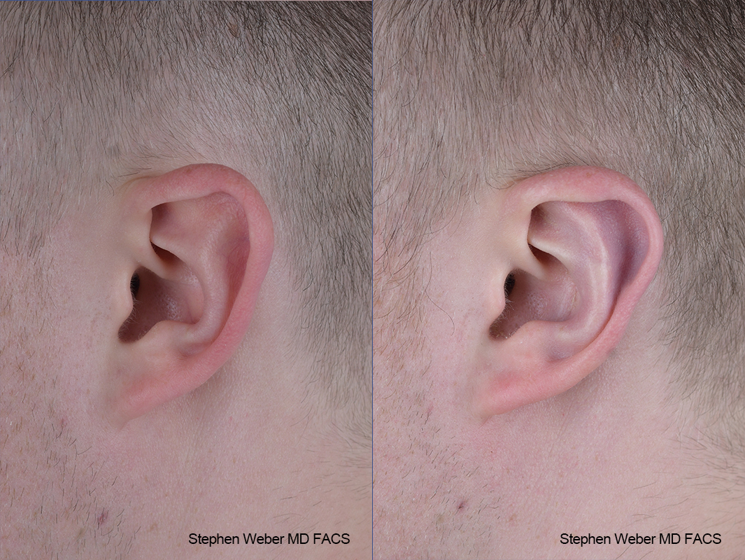 Otoplasty Before and After | Weber Facial Plastic Surgery