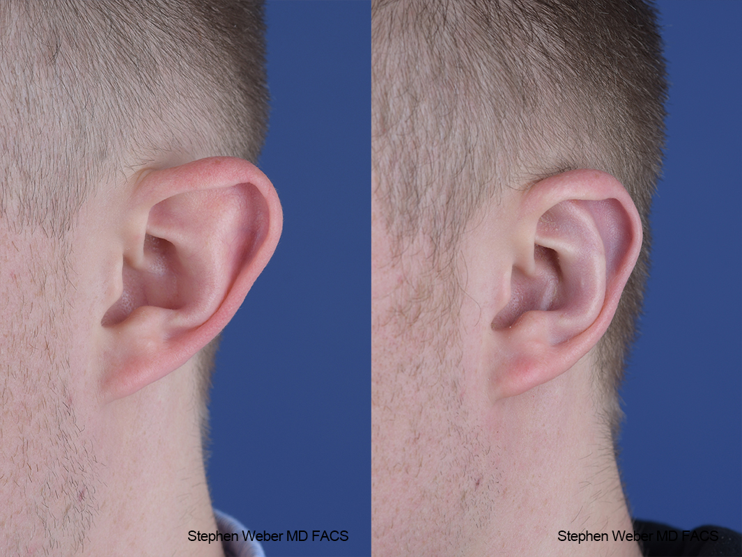 Otoplasty Before and After | Weber Facial Plastic Surgery