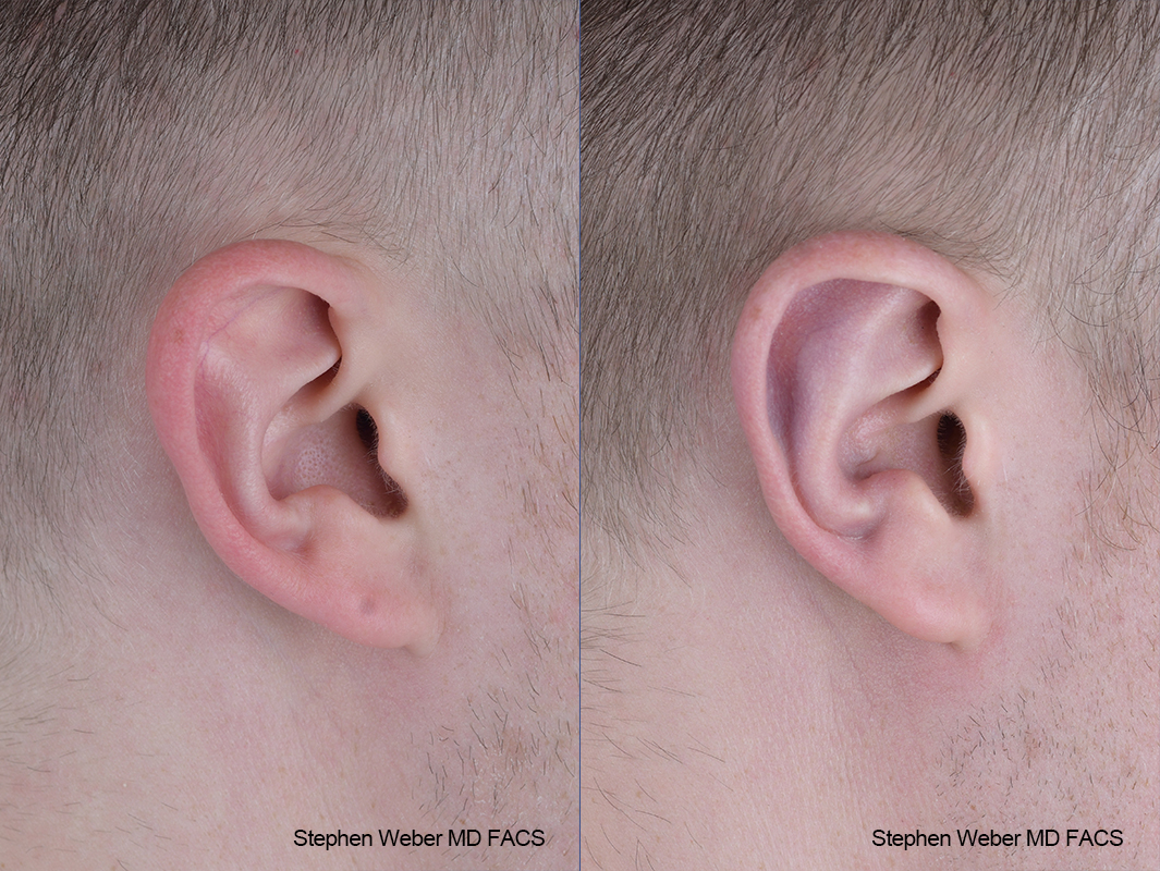Otoplasty Before and After | Weber Facial Plastic Surgery