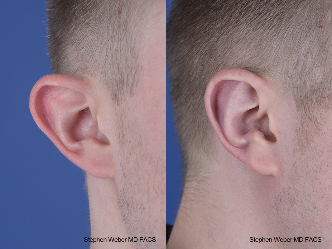 Otoplasty Before and After | Weber Facial Plastic Surgery