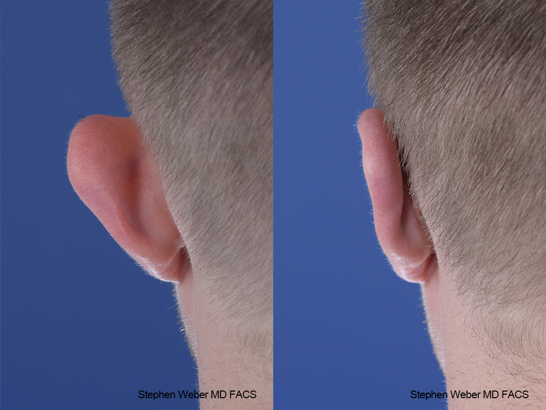 Otoplasty Before and After | Weber Facial Plastic Surgery