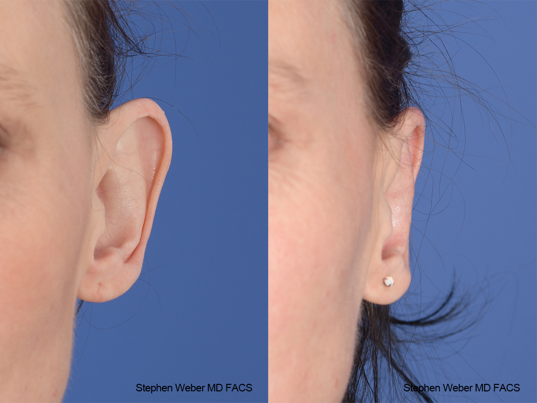 Otoplasty Before and After | Weber Facial Plastic Surgery