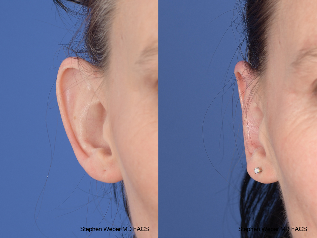 Otoplasty Before and After | Weber Facial Plastic Surgery