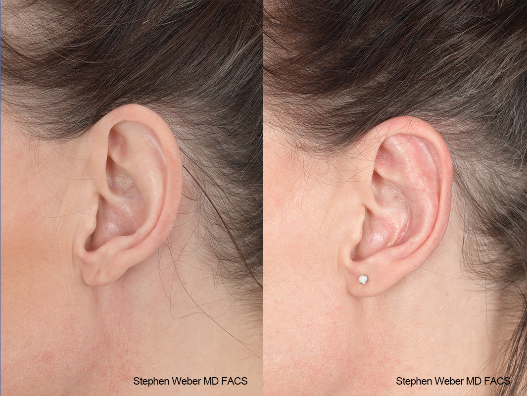 Otoplasty Before and After | Weber Facial Plastic Surgery