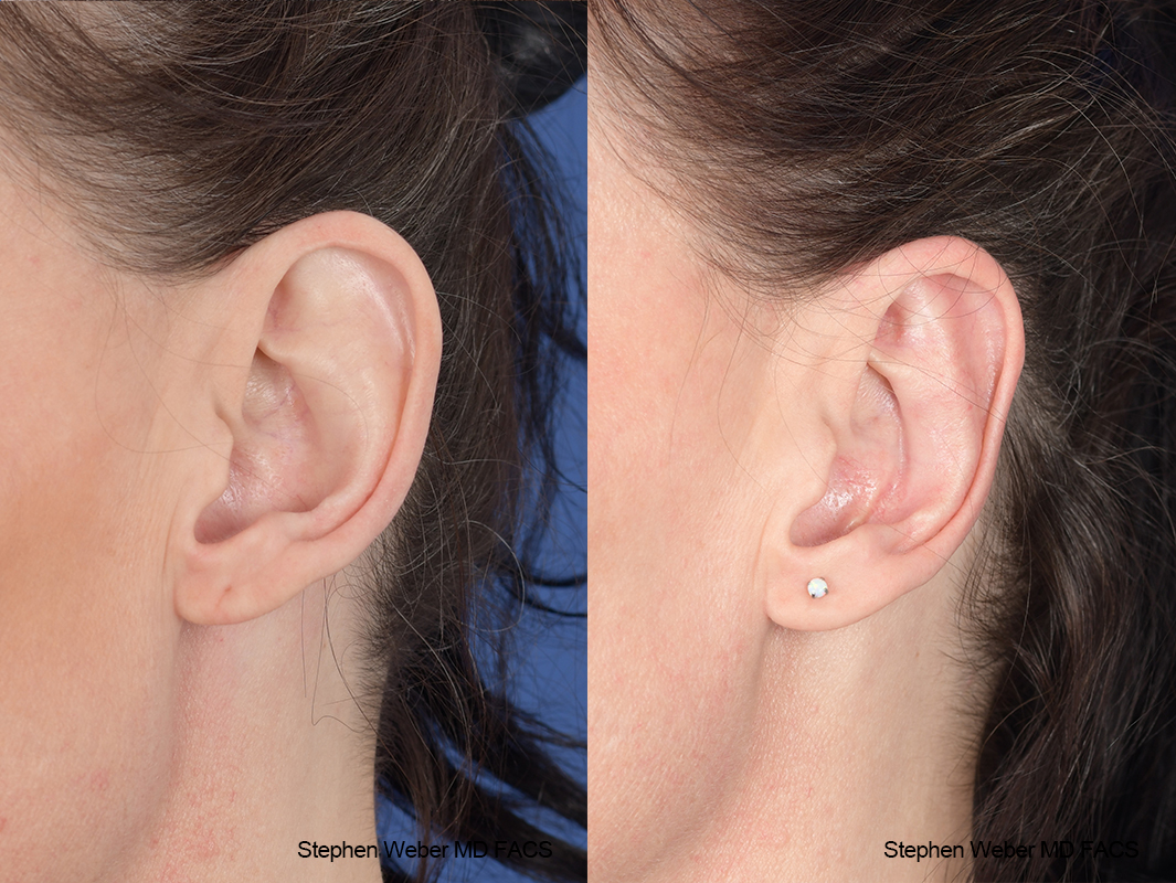 Otoplasty Before and After | Weber Facial Plastic Surgery