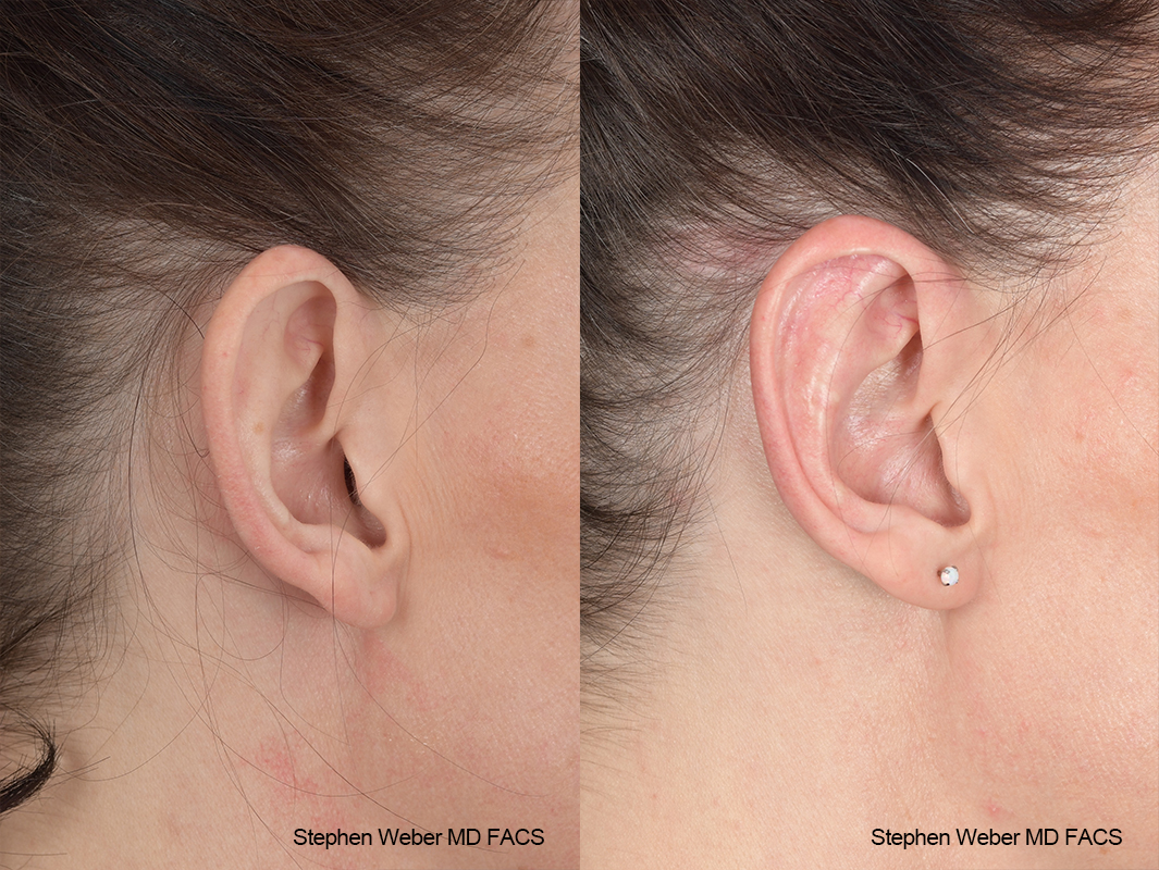 Otoplasty Before and After | Weber Facial Plastic Surgery