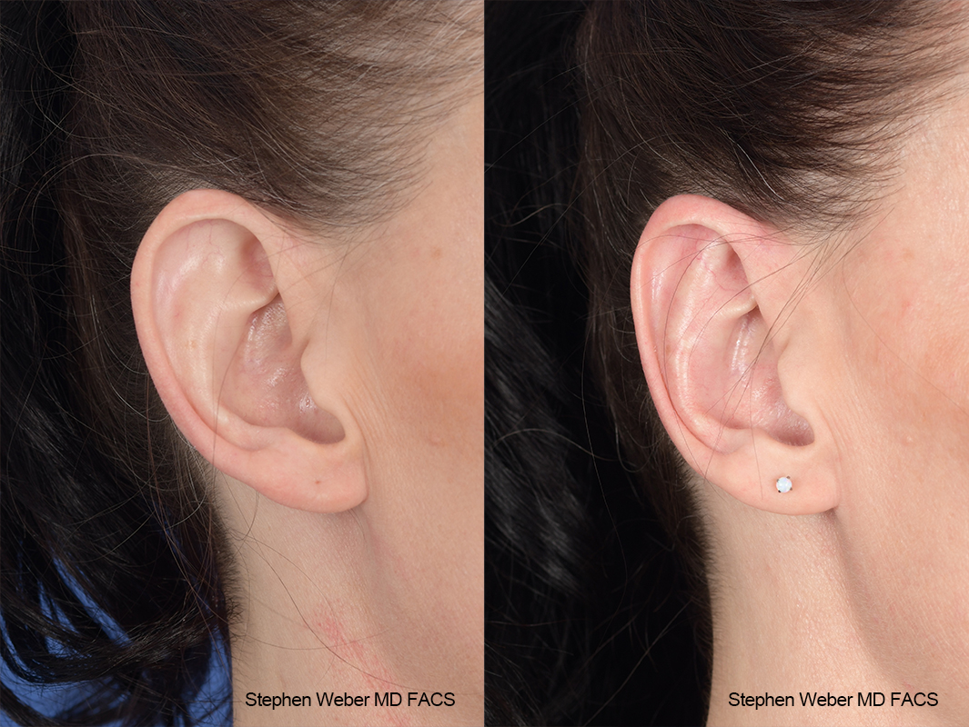 Otoplasty Before and After | Weber Facial Plastic Surgery