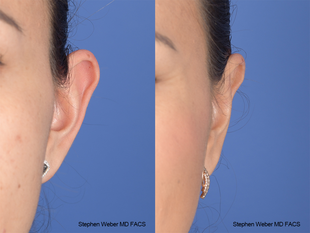 Otoplasty Before and After | Weber Facial Plastic Surgery