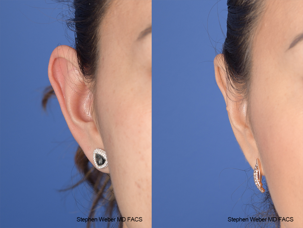 Otoplasty Before and After | Weber Facial Plastic Surgery