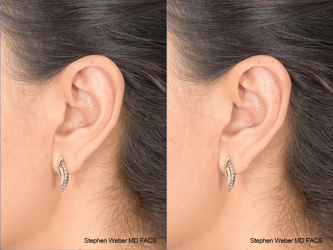 Otoplasty Before and After | Weber Facial Plastic Surgery