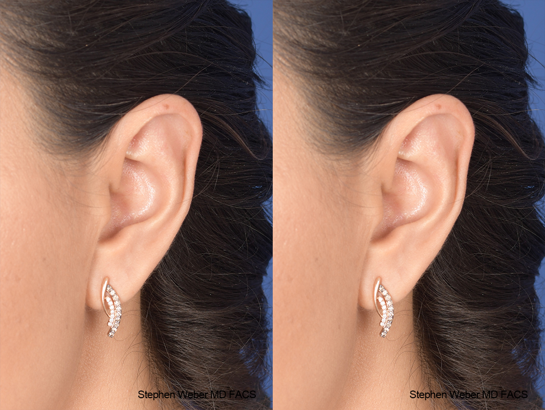 Otoplasty Before and After | Weber Facial Plastic Surgery