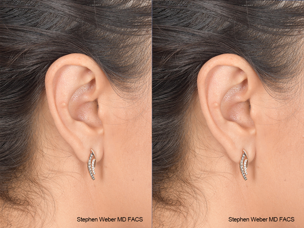 Otoplasty Before and After | Weber Facial Plastic Surgery