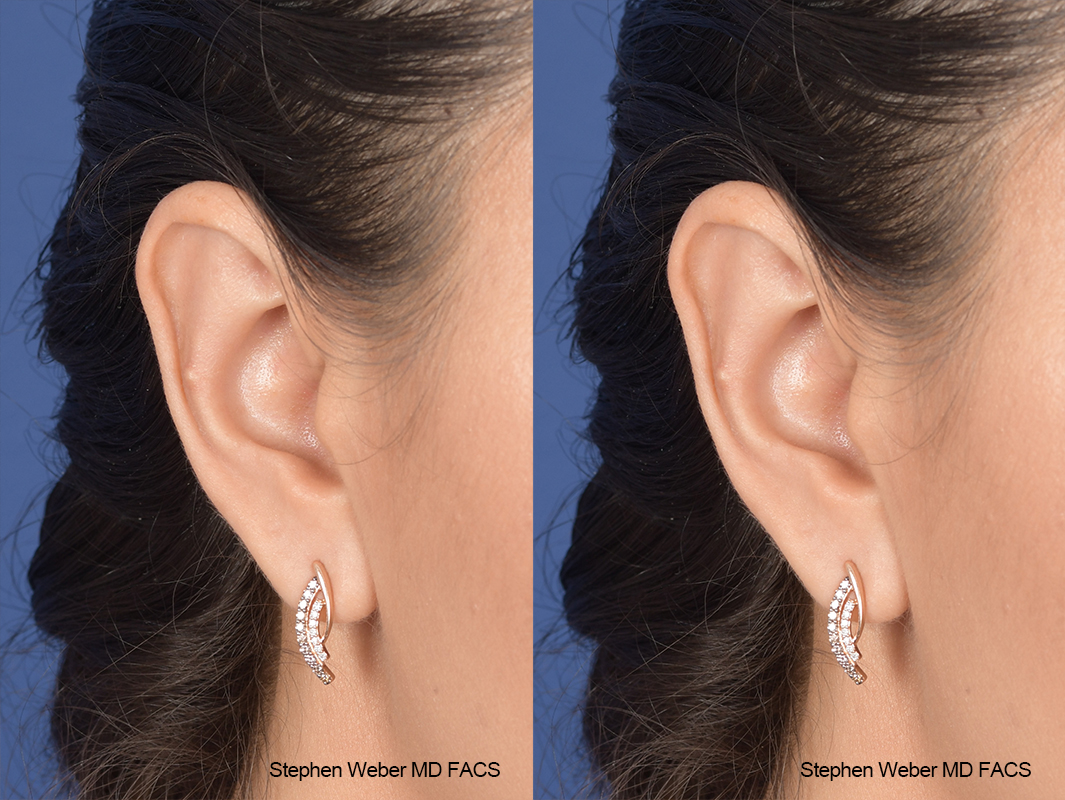 Otoplasty Before and After | Weber Facial Plastic Surgery