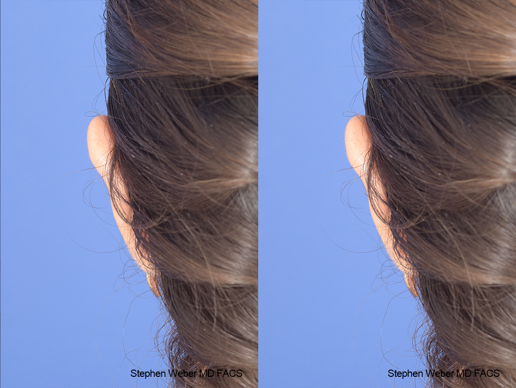 Otoplasty Before and After | Weber Facial Plastic Surgery