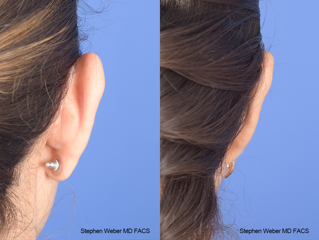 Otoplasty Before and After | Weber Facial Plastic Surgery