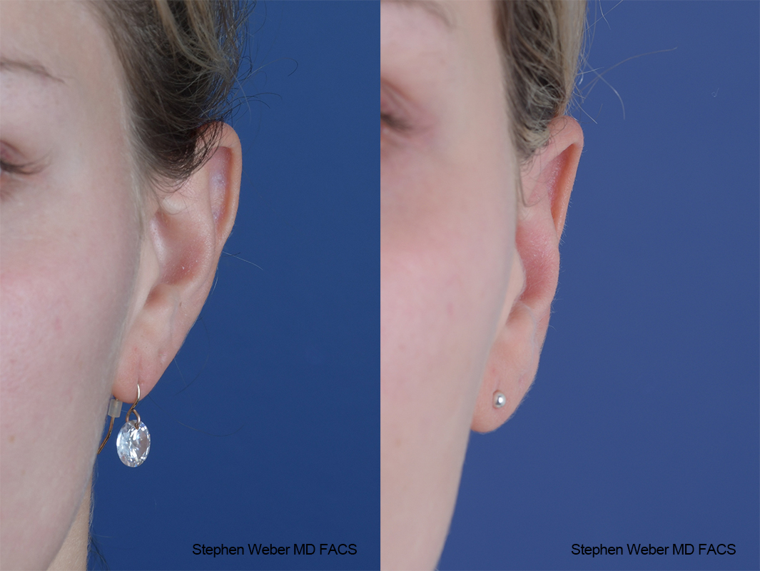 Otoplasty Before and After | Weber Facial Plastic Surgery