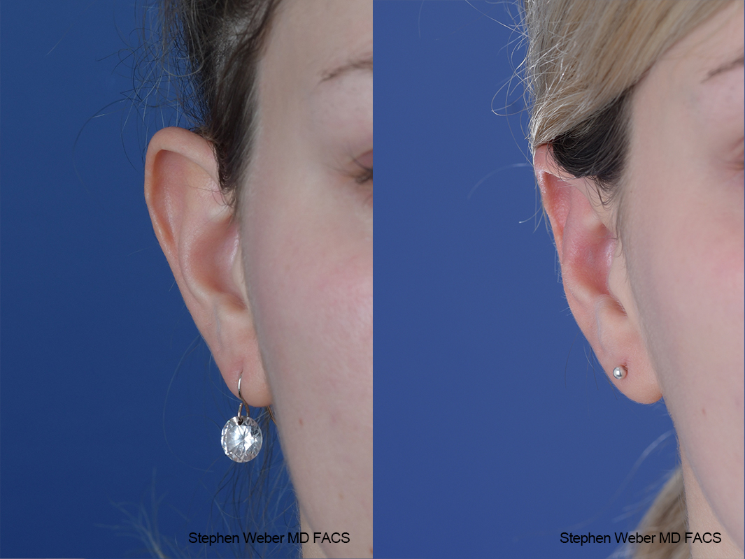 Otoplasty Before and After | Weber Facial Plastic Surgery