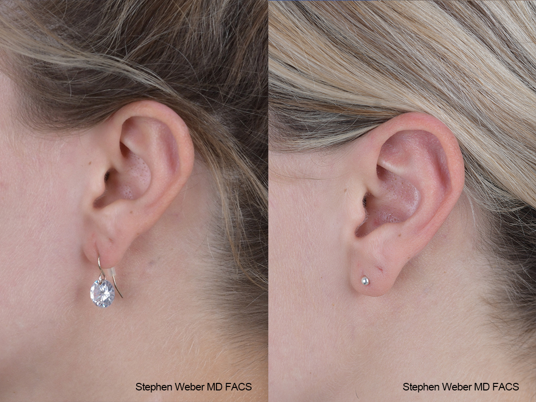 Otoplasty Before and After | Weber Facial Plastic Surgery