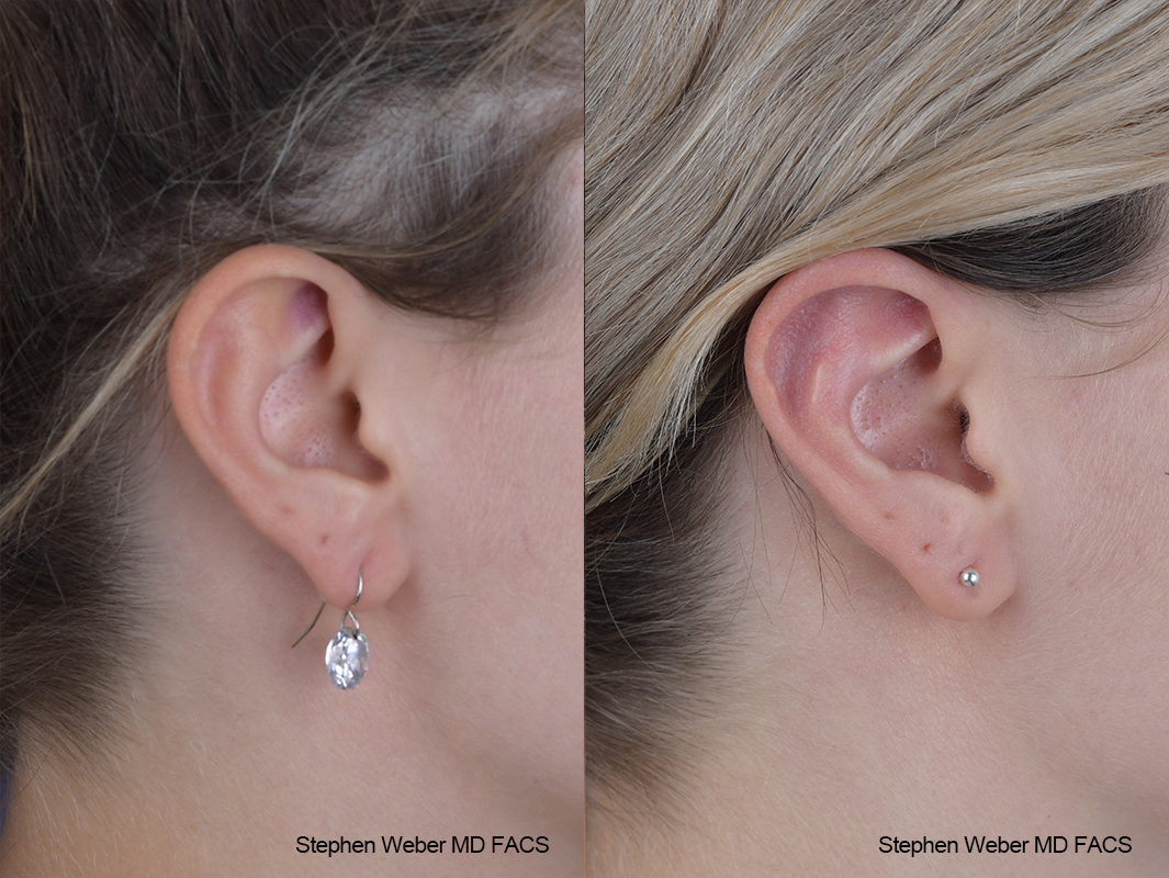 Otoplasty Before and After | Weber Facial Plastic Surgery