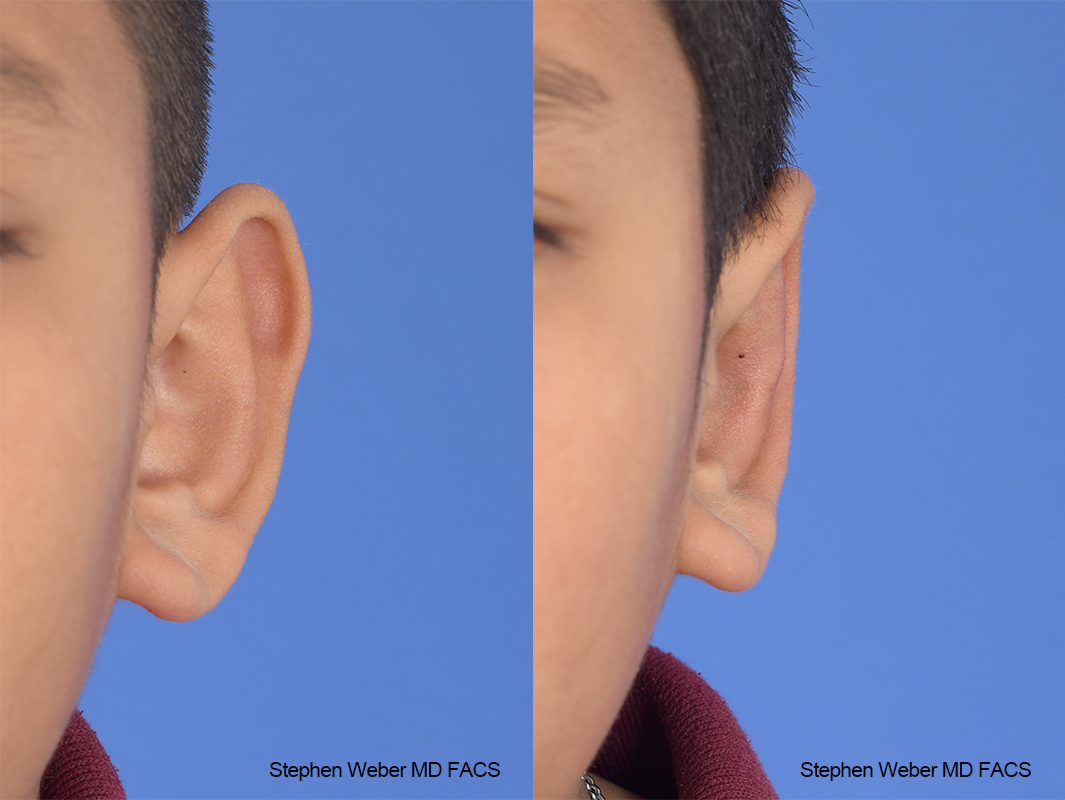 Otoplasty Before and After | Weber Facial Plastic Surgery