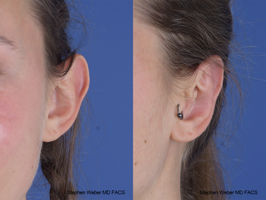 Otoplasty Before and After | Weber Facial Plastic Surgery