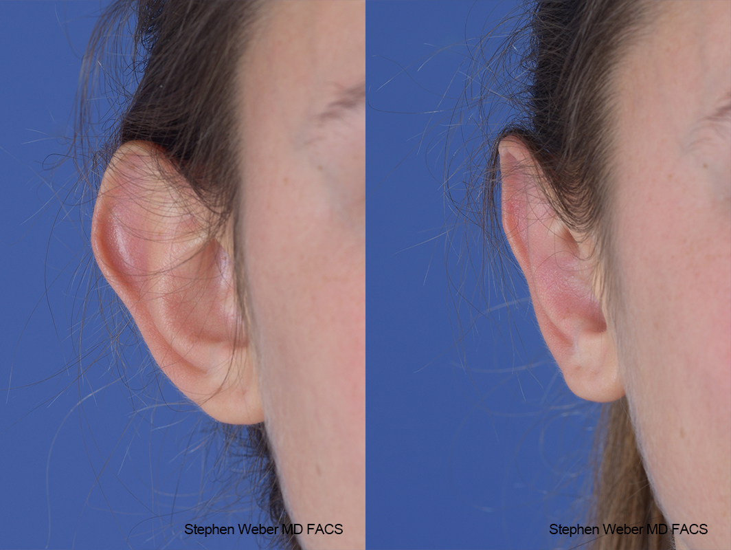 Otoplasty Before and After | Weber Facial Plastic Surgery