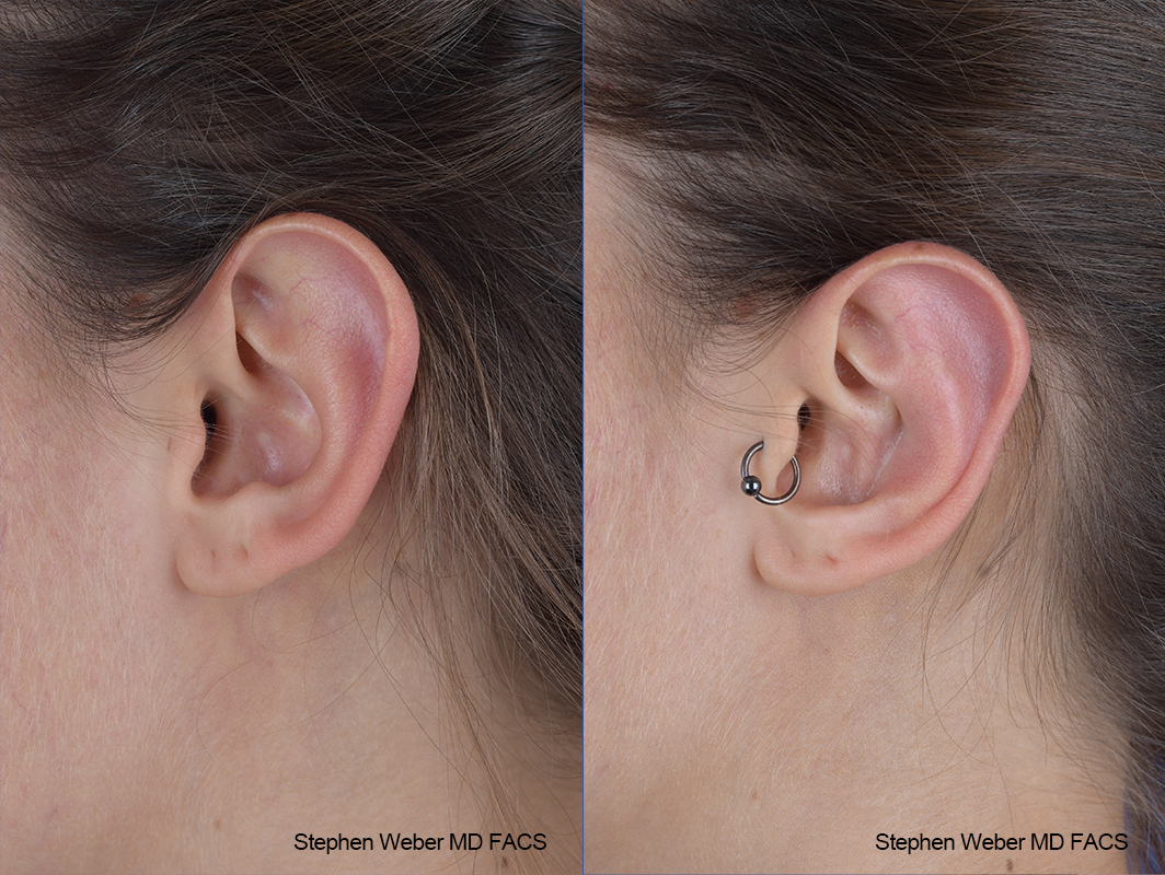 Otoplasty Before and After | Weber Facial Plastic Surgery