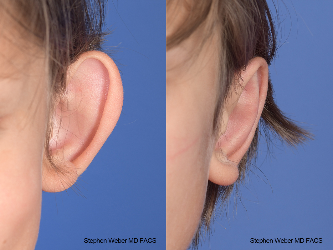 Otoplasty Before and After | Weber Facial Plastic Surgery