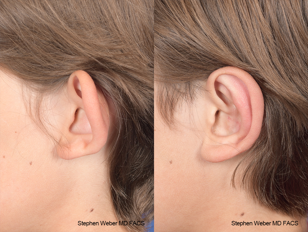 Otoplasty Before and After | Weber Facial Plastic Surgery