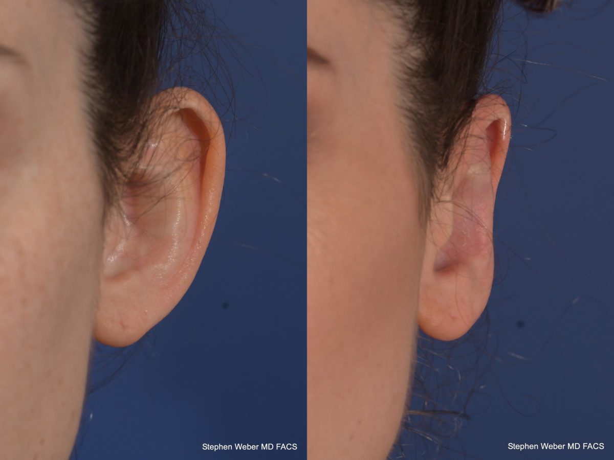 Otoplasty Before and After | Weber Facial Plastic Surgery