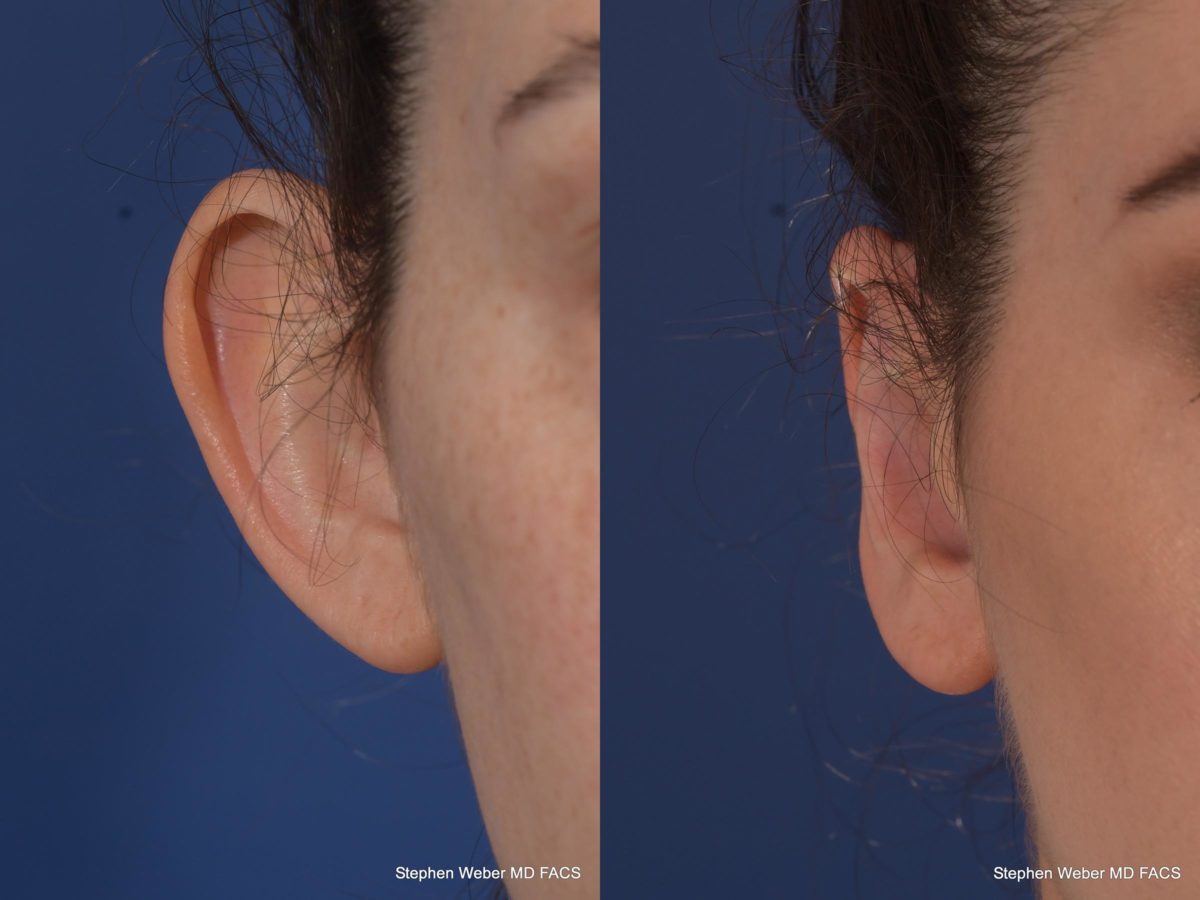 Otoplasty Before and After | Weber Facial Plastic Surgery