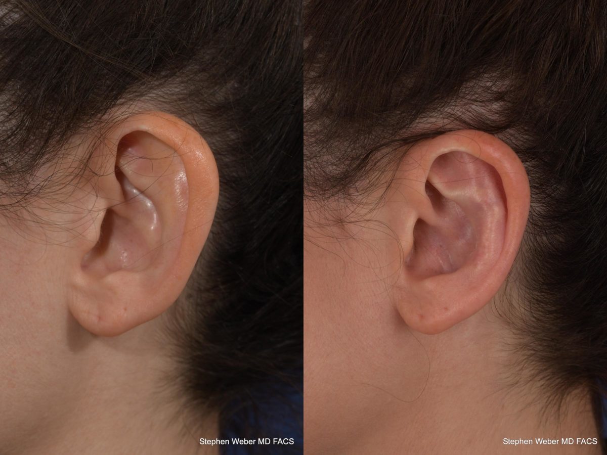 Otoplasty Before and After | Weber Facial Plastic Surgery