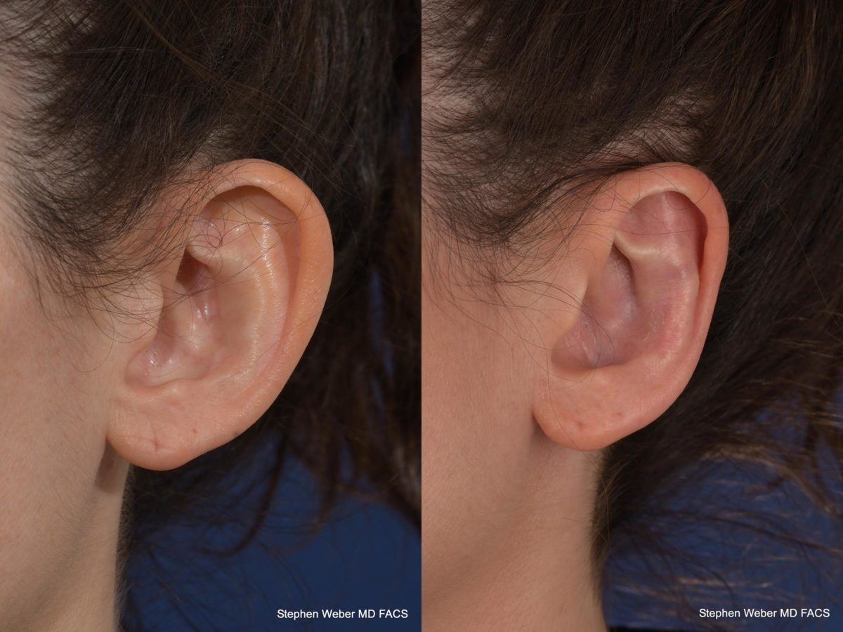 Otoplasty Before and After | Weber Facial Plastic Surgery