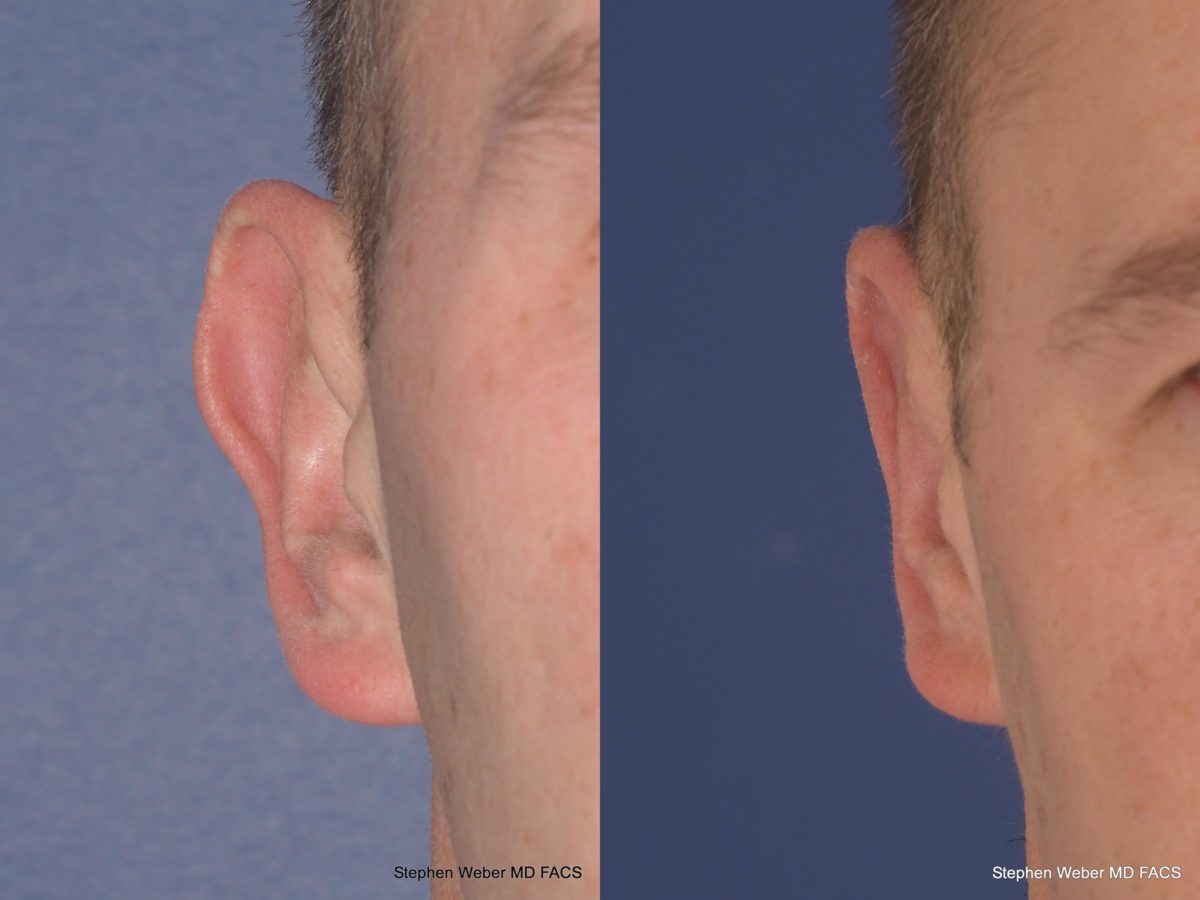 Otoplasty Before and After | Weber Facial Plastic Surgery