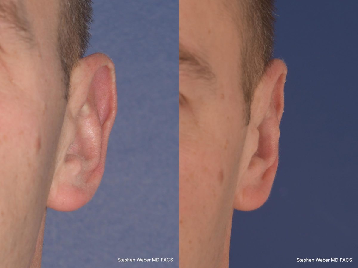 Otoplasty Before and After | Weber Facial Plastic Surgery