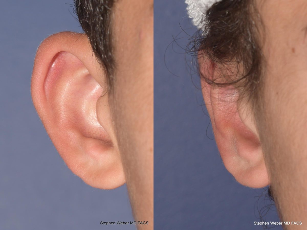 Otoplasty Before and After | Weber Facial Plastic Surgery