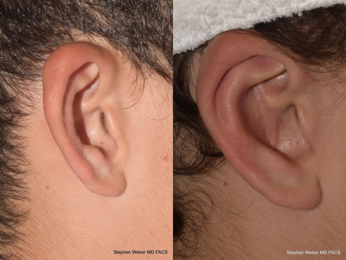 Otoplasty Before and After | Weber Facial Plastic Surgery