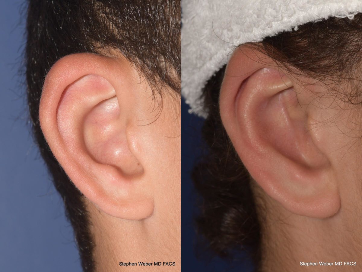 Otoplasty Before and After | Weber Facial Plastic Surgery