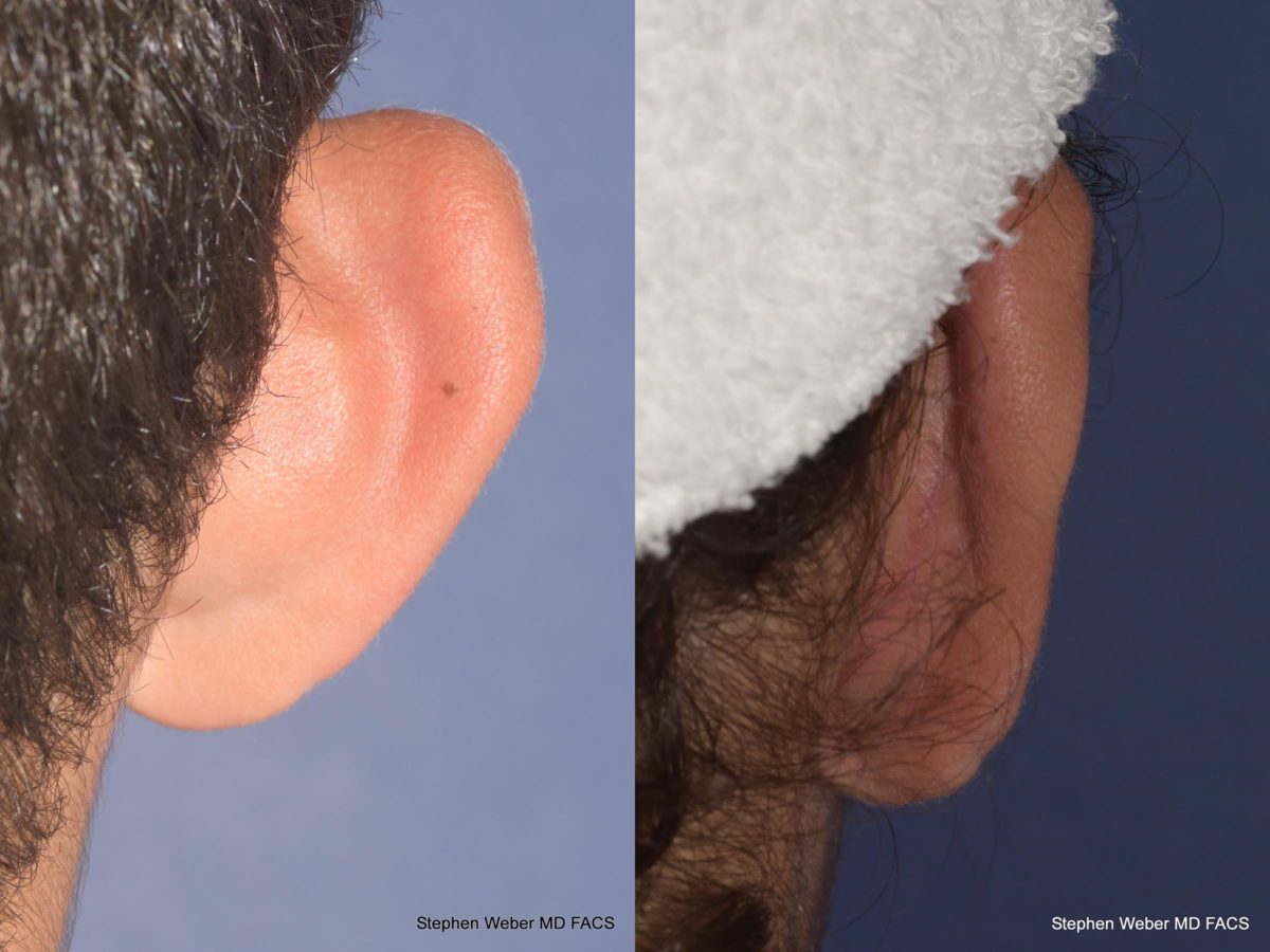 Otoplasty Before and After | Weber Facial Plastic Surgery