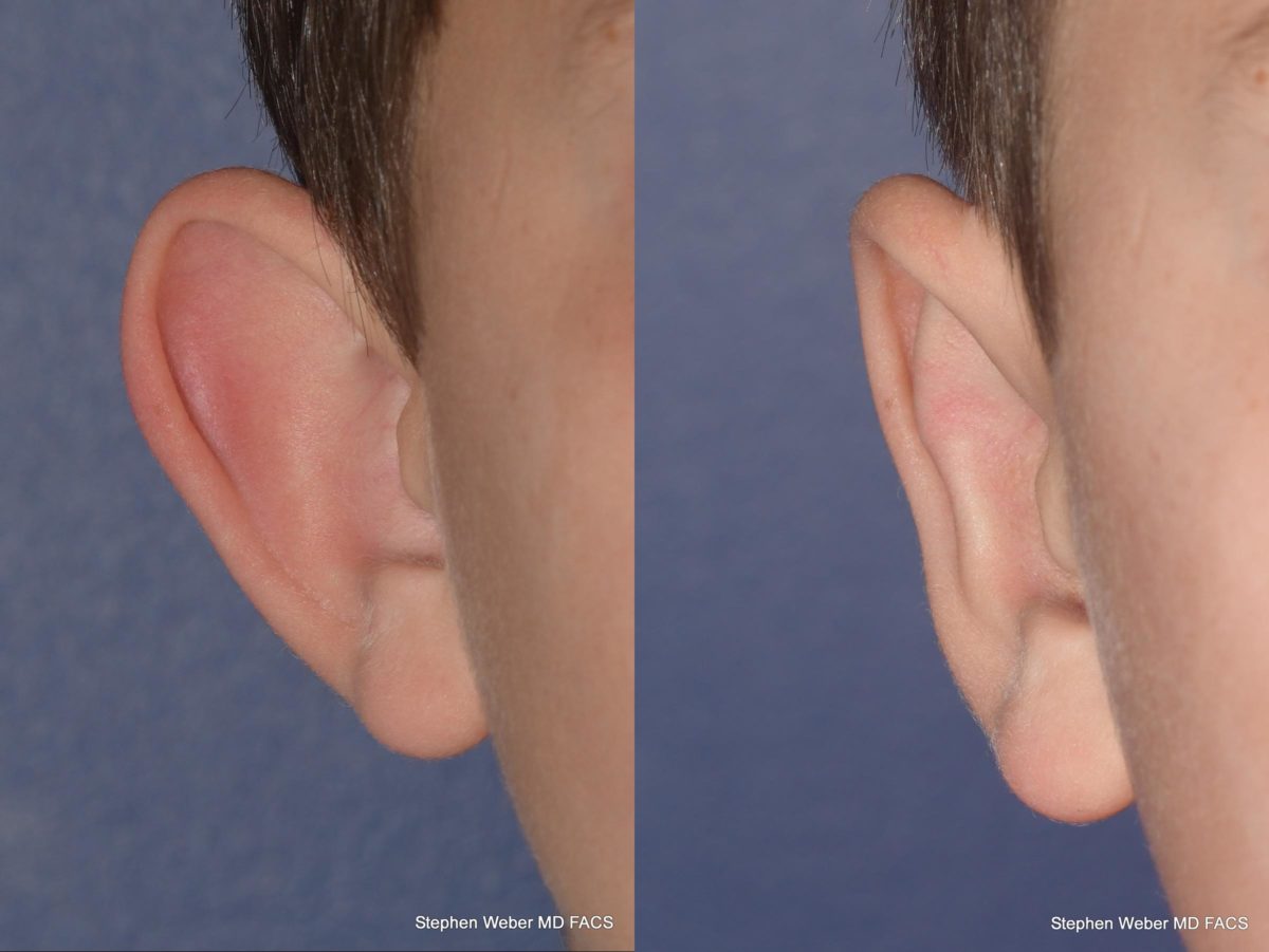 Otoplasty Before and After | Weber Facial Plastic Surgery