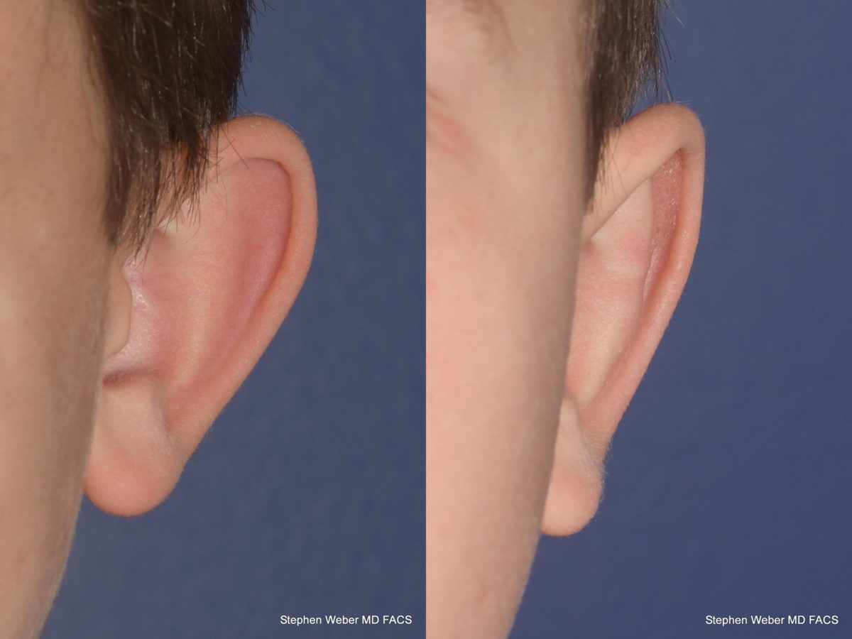 Otoplasty Before and After | Weber Facial Plastic Surgery